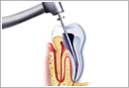 Root canal treatment