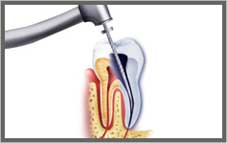 Root canal treatment