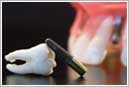 Prices for dental implants