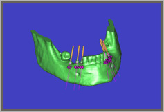 Patient evaluation and planning of the treatment  for dental implants