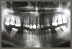 Contraindications for dental implants