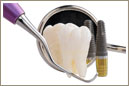 Dental implantation