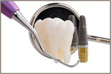 Dental implantation – Cost