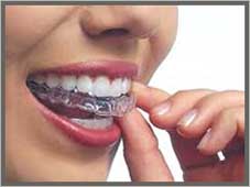 How to keep the crowns with bruxism?