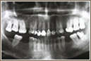 Zubní implantáty: kontraindikace