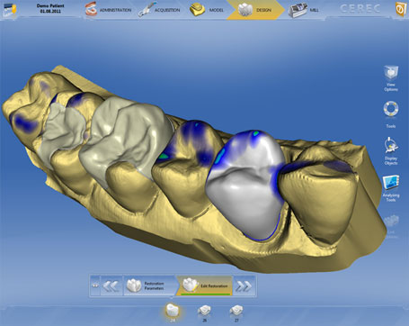 Korunky a fazety technologie CAD/CAM 3D CEREC